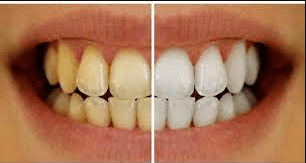 teeth cleaning before and after